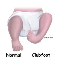 Clubfoot | Dayton Children's Hospital