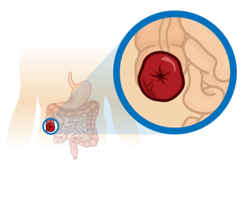 colostomy