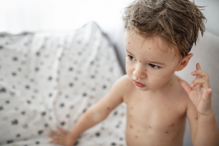 boy with chicken pox