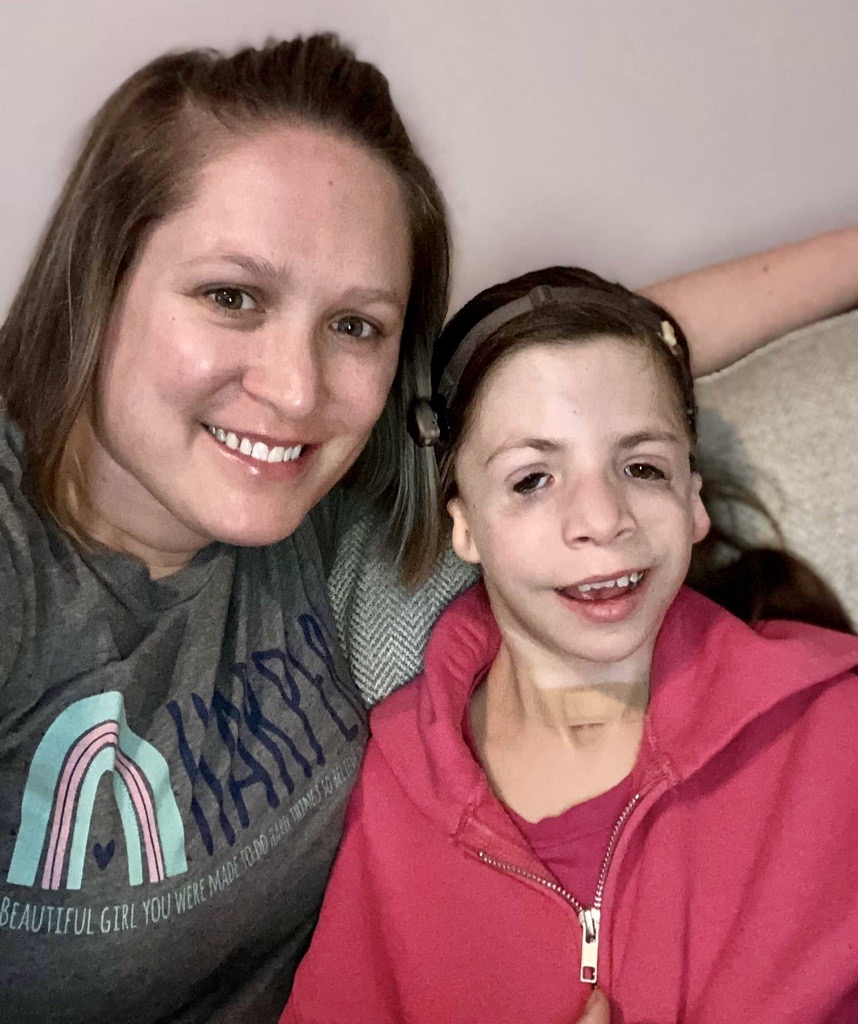 Mandibulofacial Dysostosis with Microcephaly (MFDM)