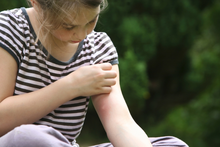 bug bites